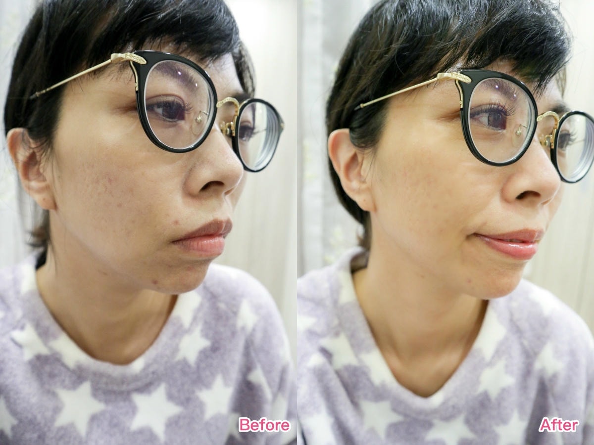 痘痘凝膠差異BA.jpg 痘痘凝膠差異BA.jpg